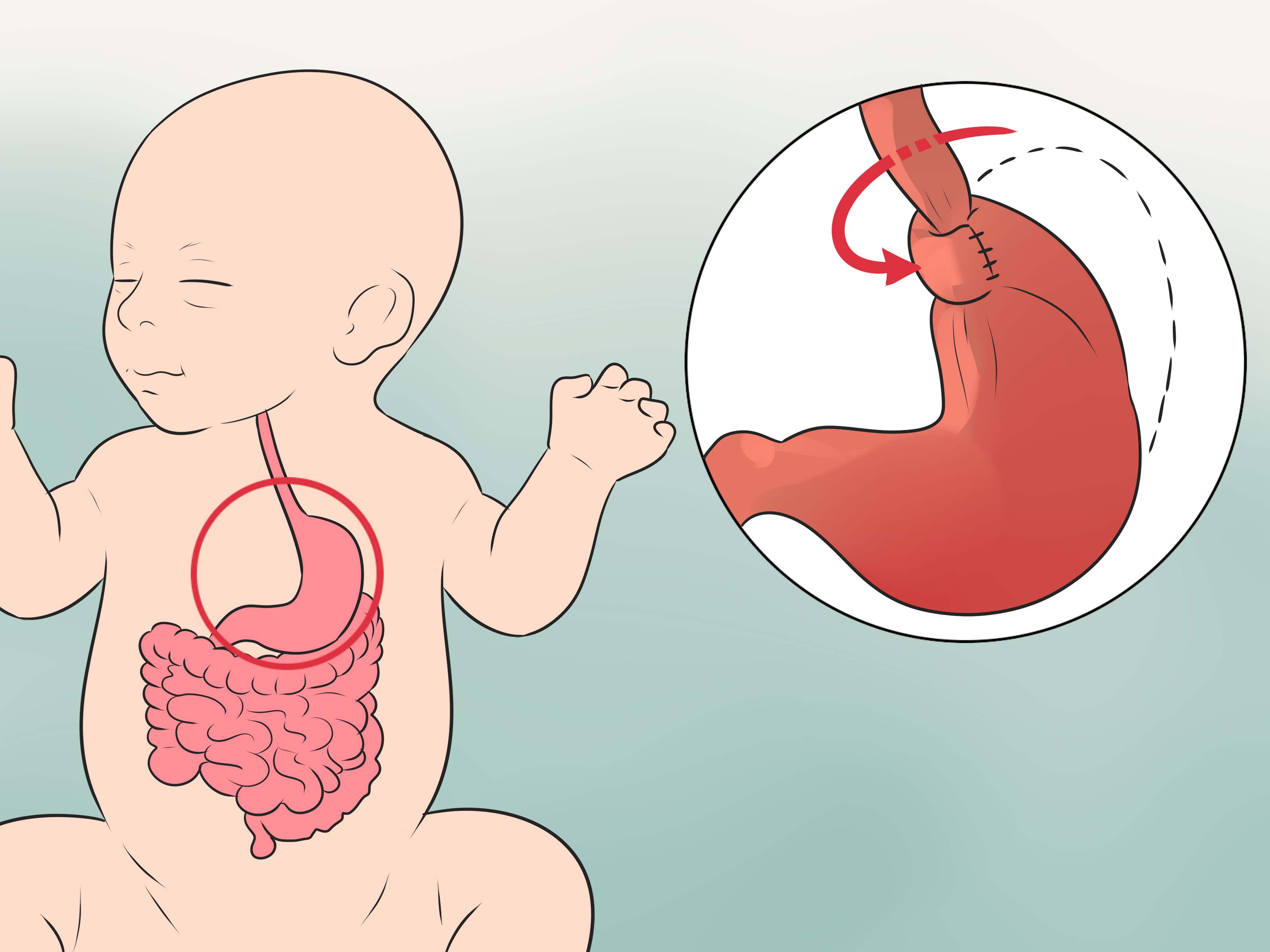 How to Treat Acid Reflux in Newborns: 11 Steps