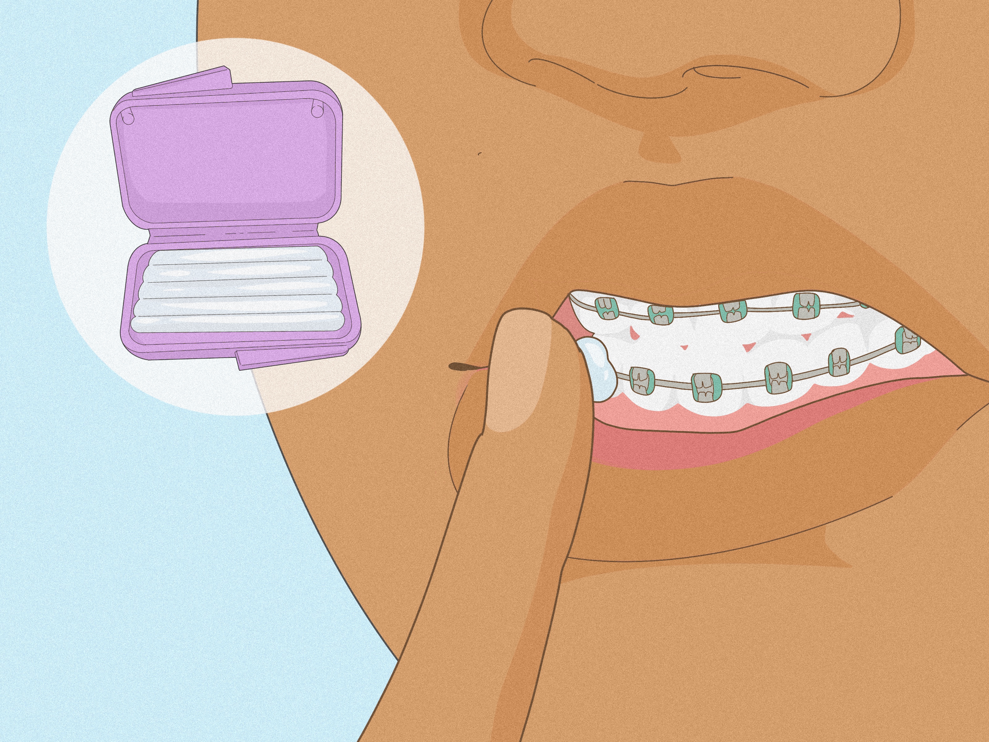How to Soothe the Pain of New or Tightened Braces: Easy Tips